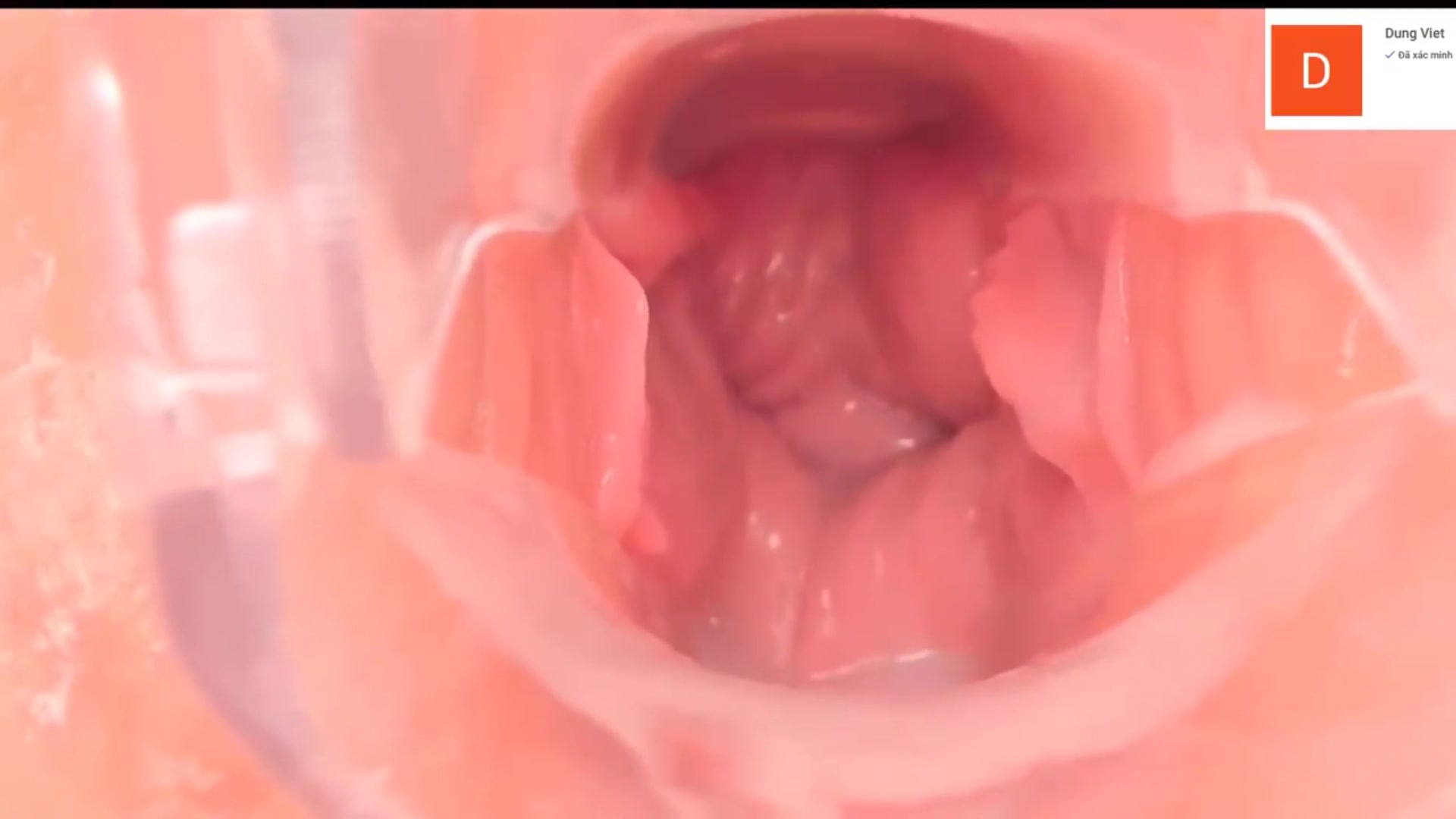 某美容美体医院内部流出高清内窥镜下女性阴道内部运动变化太粉嫩了怪不得肉棒都喜欢往里进